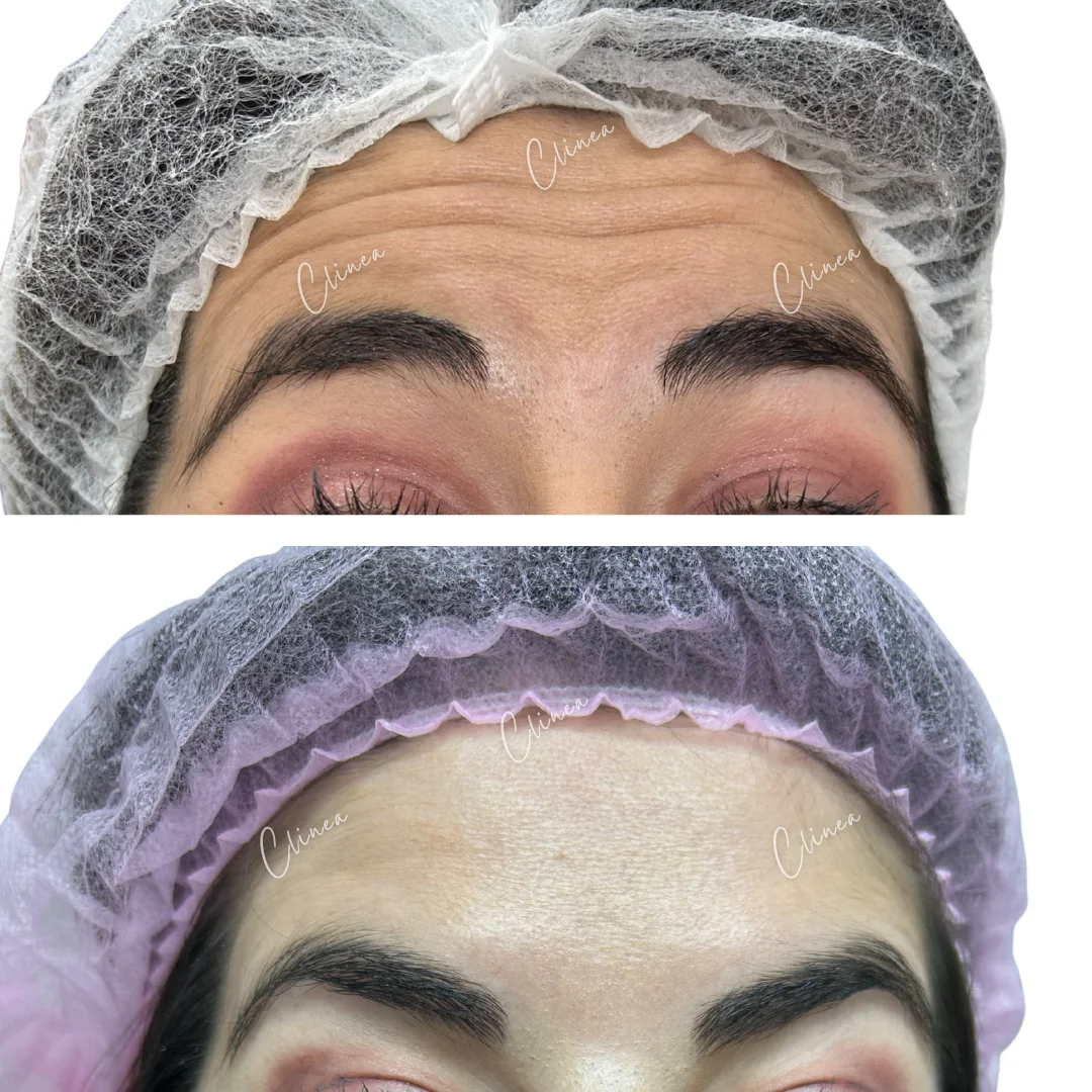 Antes y después de botox en entrecejo, Pasto