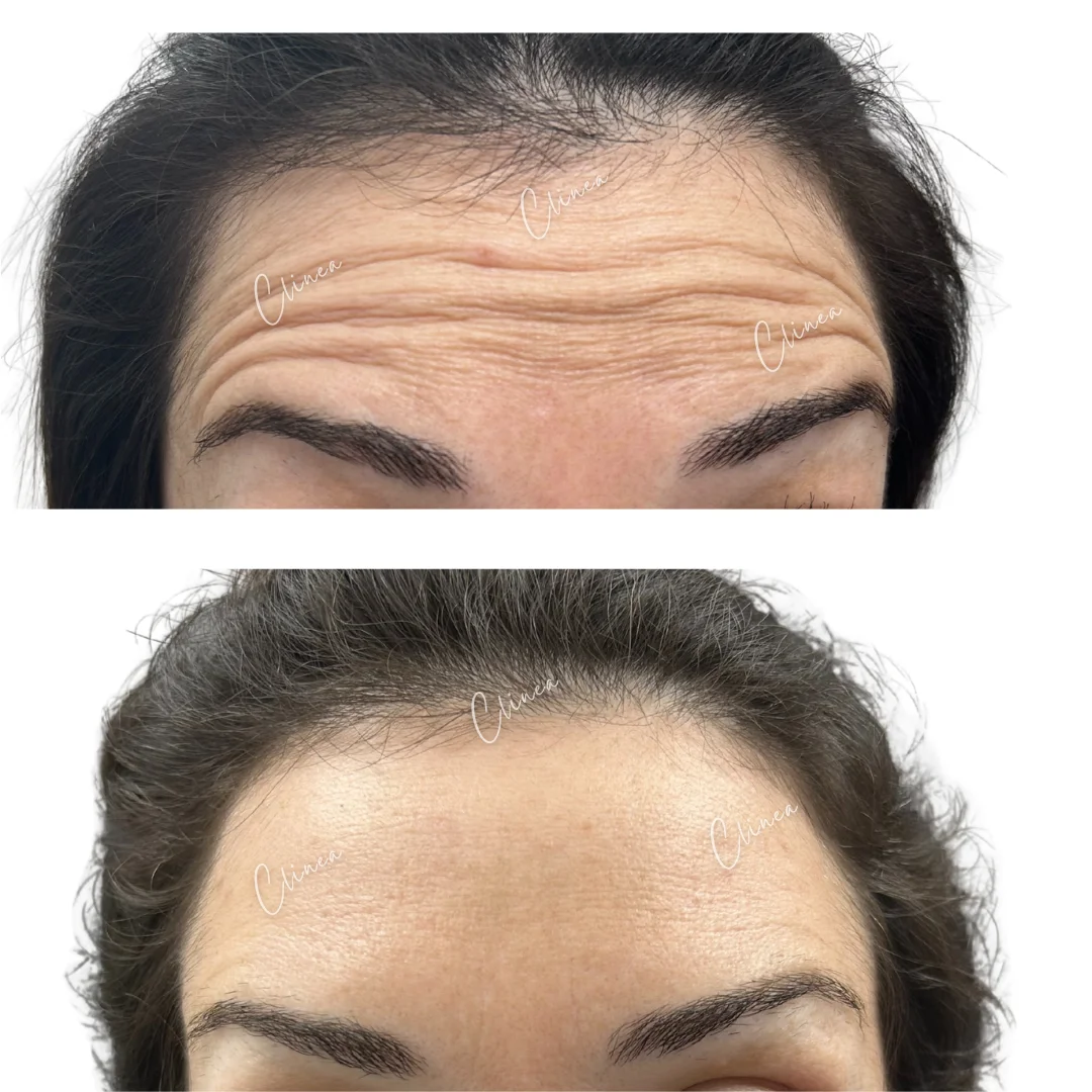 Antes y después de botox en líneas de la frente, Pasto