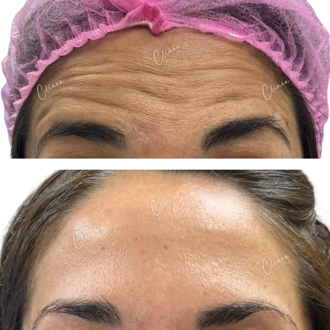 Antes y después de botox en frente, Pasto